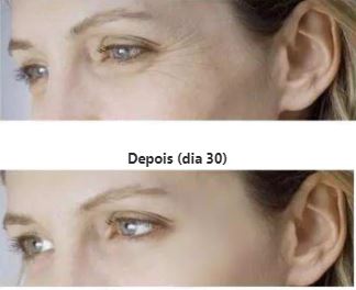 Rugas Zero, Adesivos Reutilizáveis de Silicone Anti Rugas efeito Botox